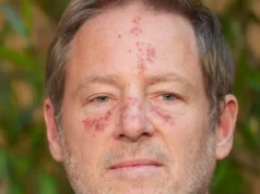 Manchas estranhas no rosto – preocupação do vencedor do Oscar Florian Gallenberger