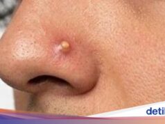 O ‘piercing de espinha’ virou uma nova tendência, piercings parecidos com espinhas no nariz.